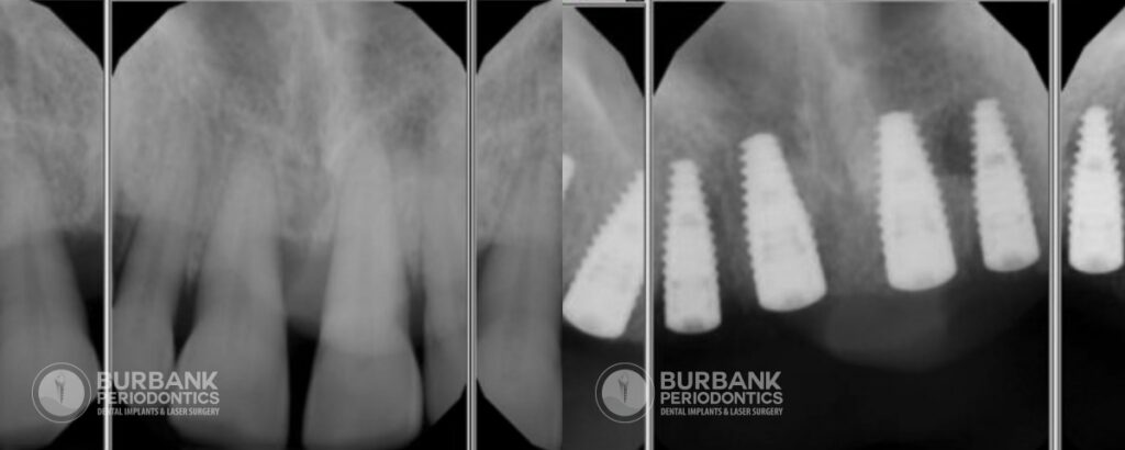 burbank periodontics dental implants Patient 7b